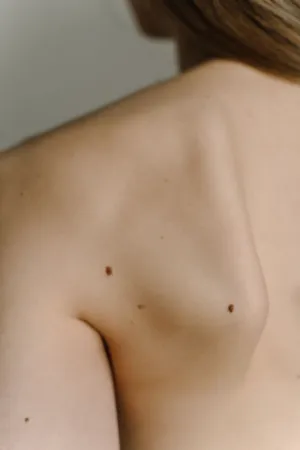 Naked Shoulder With Moles