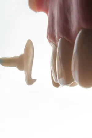 Dental Implant